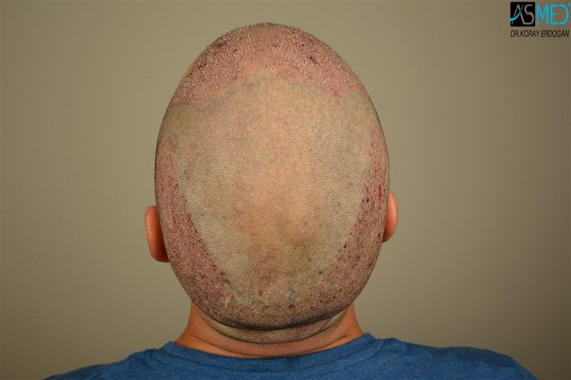 Can Hair Transplant Reduce Visible Hair Loss Signs?