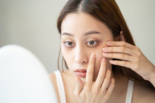 Can Dark Circles Treatment Help Reduce Stubborn Eye Shadows?