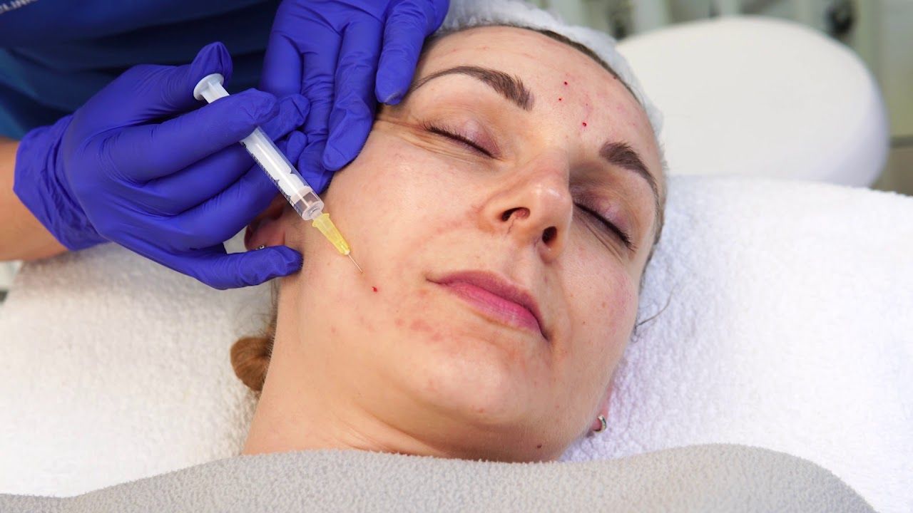 Does Vampire Facial Help Improve the Look of Fine Skin Lines?