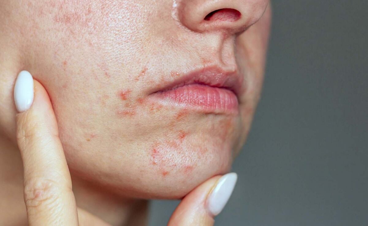 Is Acne Treatment Helpful for Managing Skin Prone to Blemishes?