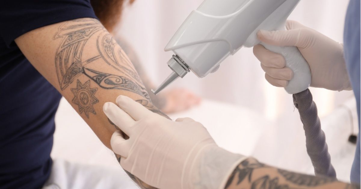 Is Tattoo Removal a Good Choice for Unwanted Tattoos Today?