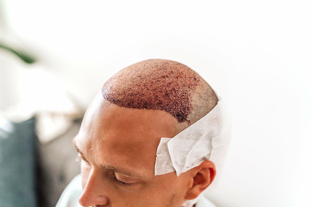 Is Hair Transplant Helpful for Improving Hairline Balance?