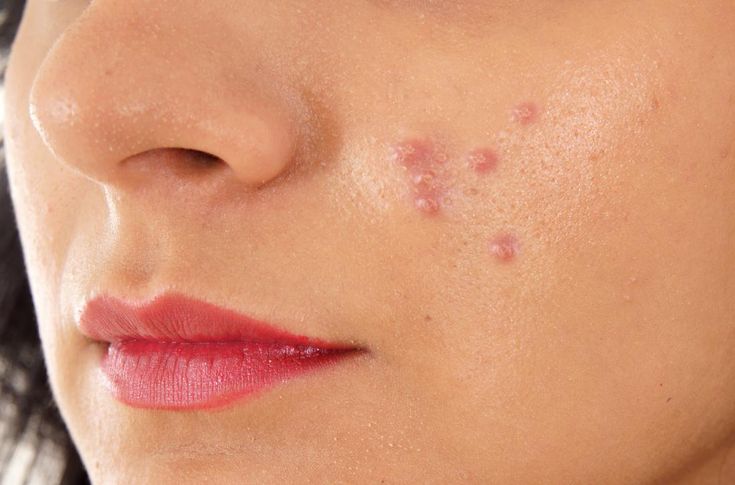 What Makes Pimples Treatment Ideal for Managing Facial Acne?
